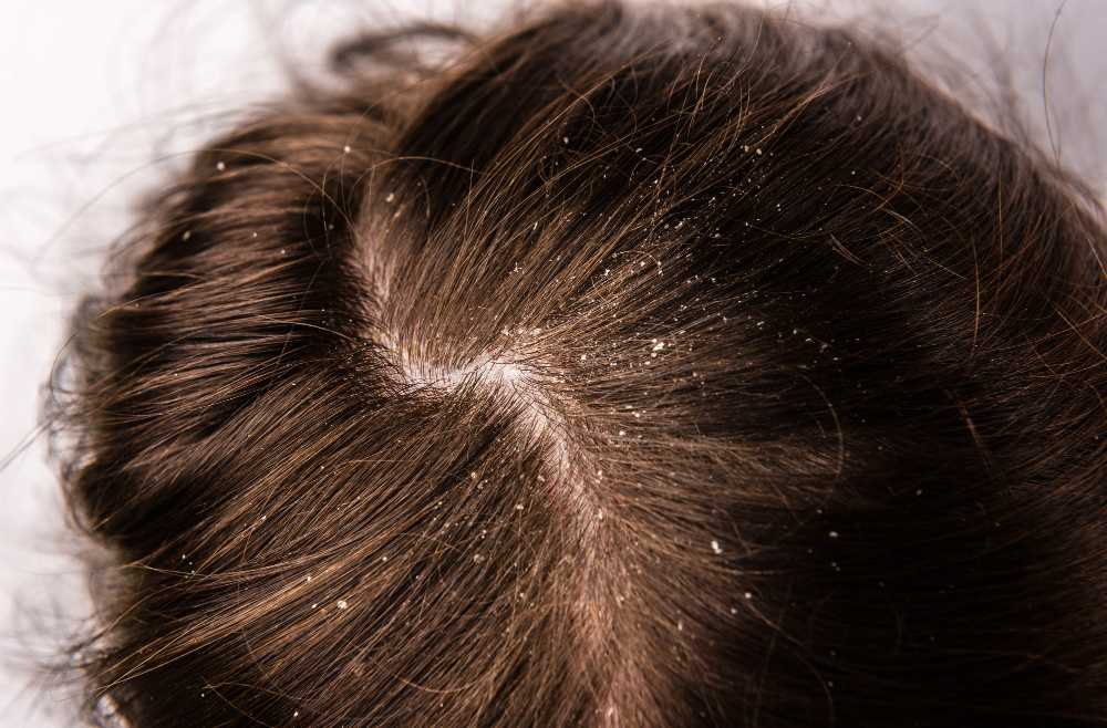 Dandruff in Winter vs. Summer: Why It Happens and How to Prevent It