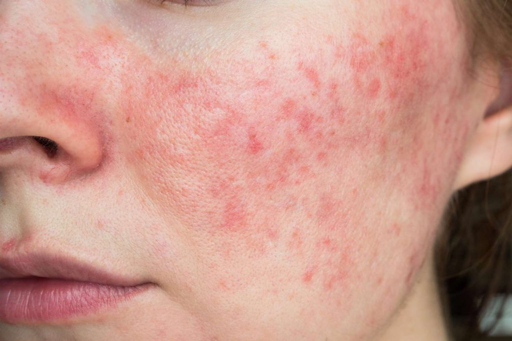 Top Facial Rash Causes Everyone Should Know About